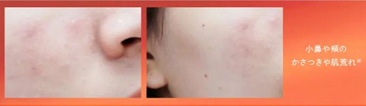 小鼻や頬の
かさつきや肌荒れ ※
頬やおでこ、
周りの急な
大人ニキビ
※二
有効成分が持つ
