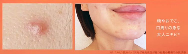 小鼻や頬の
かさつきや肌荒れ ※
頬やおでこ、
周りの急な
大人ニキビ
※二
有効成分が持つ