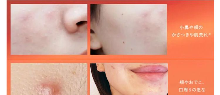 ※1 ニキビ・肌あれ
小鼻や頬の
かさつきや肌荒れ ※
頬やおでこ、
口周りの急な
大人ニキビ
多量の汗やベタつき、 エアコンによる乾燥、
シミや大人ニキビ、肌の赤み･･･
夏は肌トラブルが多くなる季節。
この状態
※ ニキビ・肌あれシミなど有効成分が持つ効能の範囲での肌状態